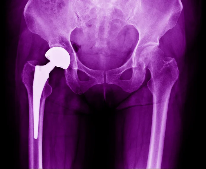 Total Hip Replacement Surgery  Orthopedic Associates of Hartford